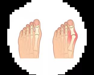 Hallux valgus jalka